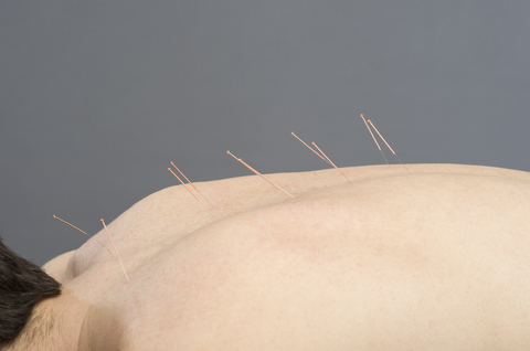 myotherapy-dry-needling